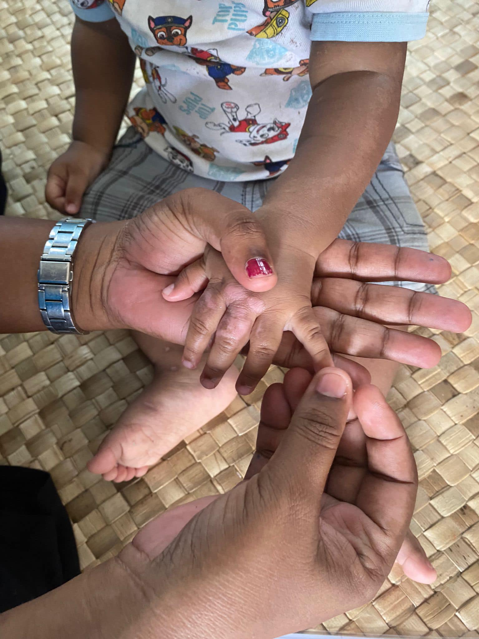 Conducting a skin examination on a child in Western Province, WSP 2024